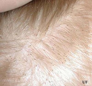 Head lice nitts on human scalp