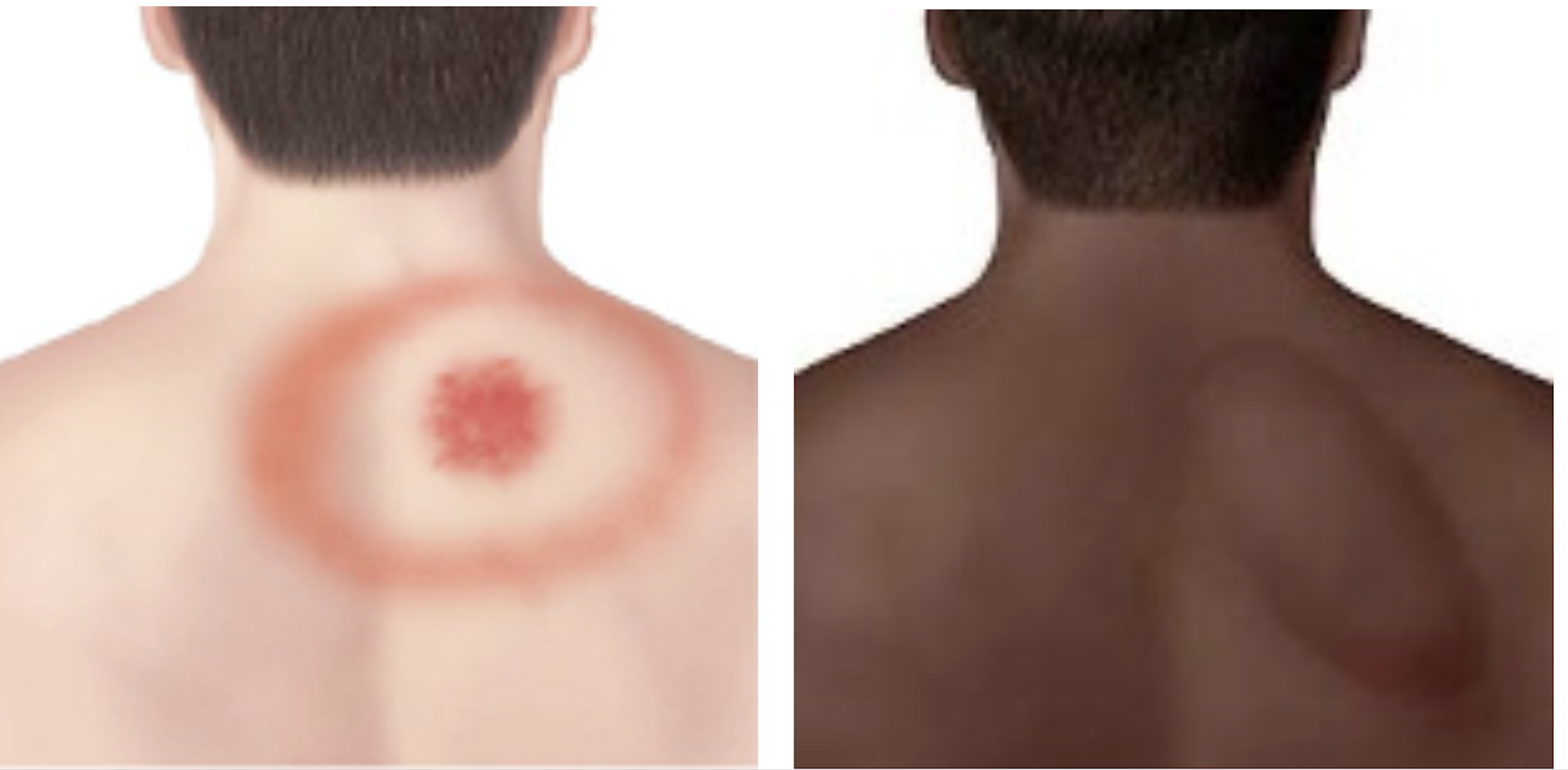 Erythema migrans examples